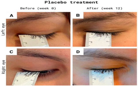Get Free Eyelashes for Cancer Patients: Top Resources and Programs